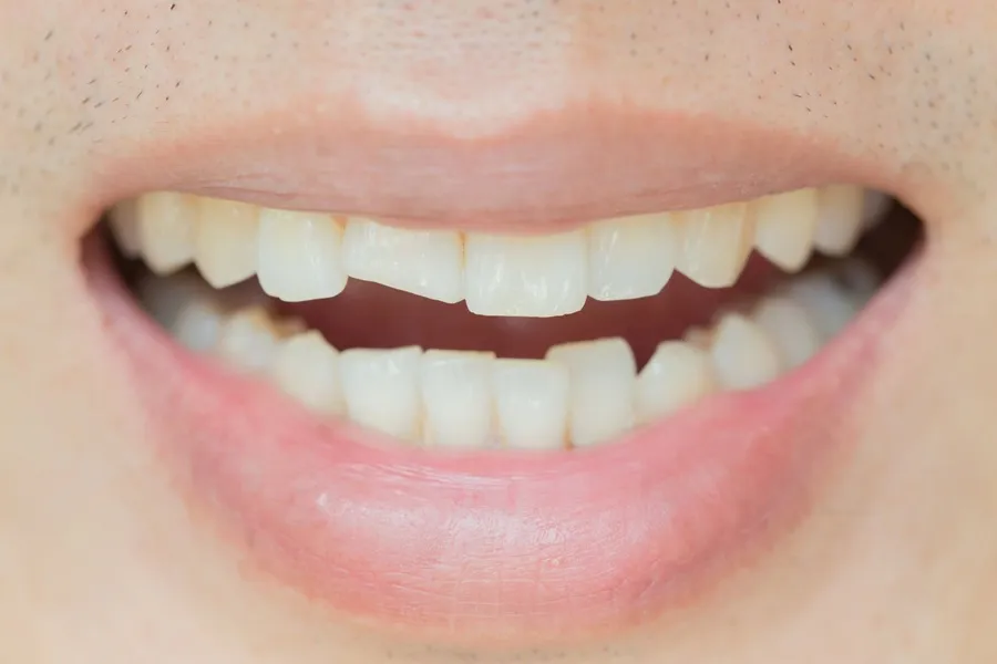 How To Fix Chipped Tooth At Home