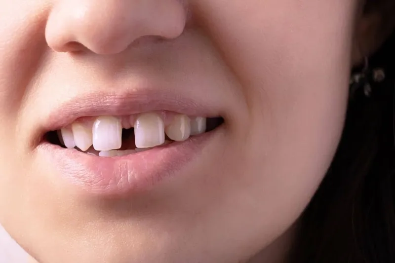 fix teeth gap