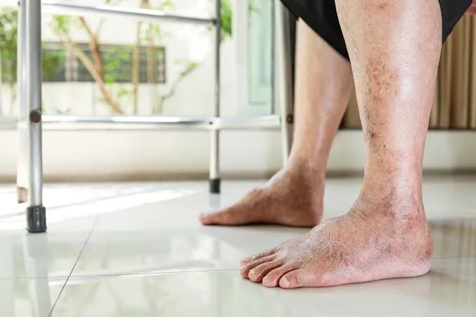 How Peripheral Vascular Disease Affects Mobility and Quality of Life